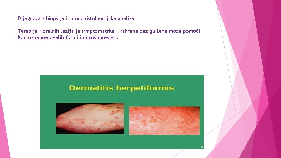 Dijagnoza – biopsija i imunohistohemijska analiza Terapija – oralnih lezija je simptomatska , ishrana