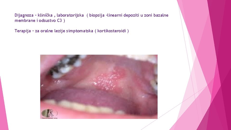 Dijagnoza – klinička , laboratorijska ( biopsija –linearni depoziti u zoni bazalne membrane i