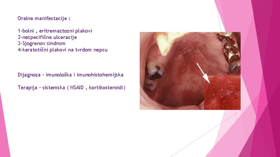 Oralne manifestacije : 1 -bolni , eritremaztozni plakovi 2 -nespecifične ulceracije 3 -Sjogrenov sindrom