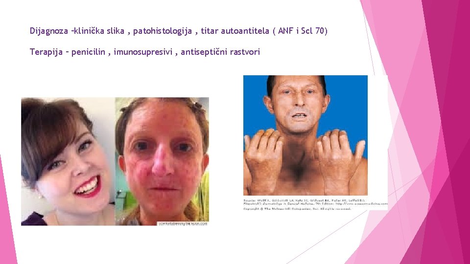 Dijagnoza –klinička slika , patohistologija , titar autoantitela ( ANF i Scl 70) Terapija
