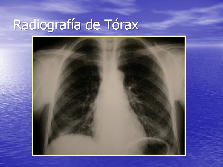 Radiografía de Tórax 