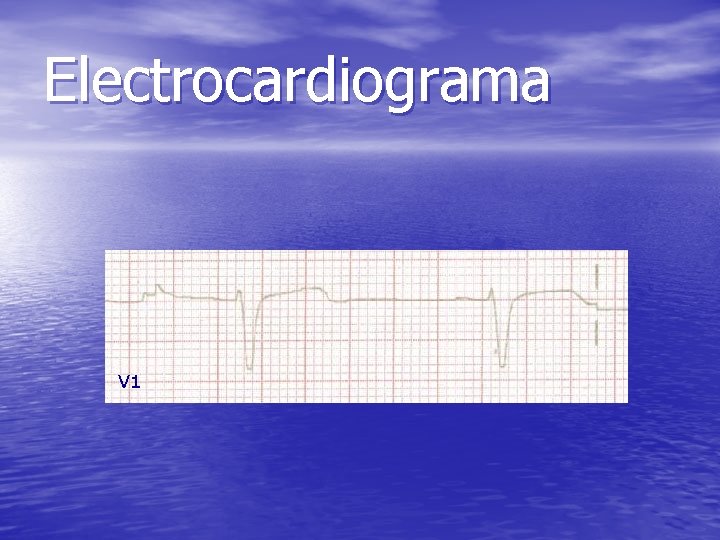 Electrocardiograma V 1 