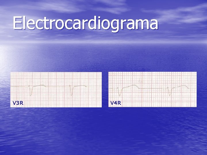 Electrocardiograma V 3 R V 4 R 