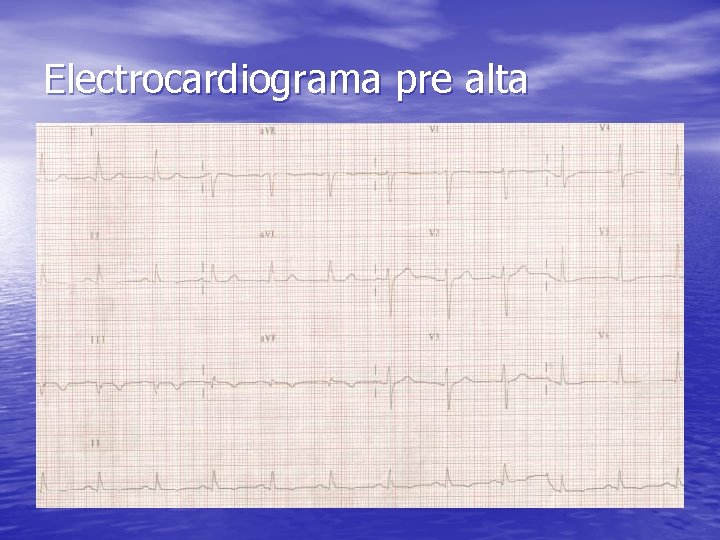 Electrocardiograma pre alta 