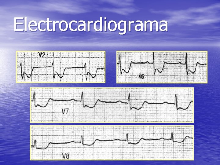 Electrocardiograma 