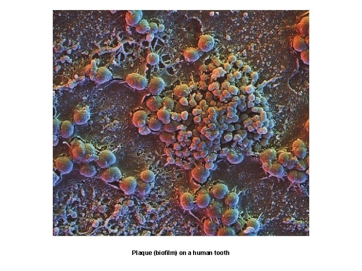 Plaque (biofilm) on a human tooth 