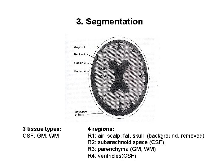 3. Segmentation 3 tissue types: CSF, GM, WM 4 regions: R 1: air, scalp,