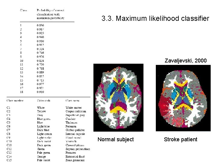 3. 3. Maximum likelihood classifier Zavaljevski, 2000 Normal subject Stroke patient 