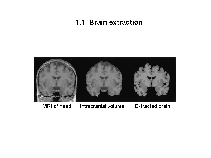 1. 1. Brain extraction MRI of head Intracranial volume Extracted brain 