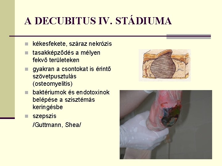A DECUBITUS IV. STÁDIUMA n kékesfekete, száraz nekrózis n tasakképződés a mélyen fekvő területeken