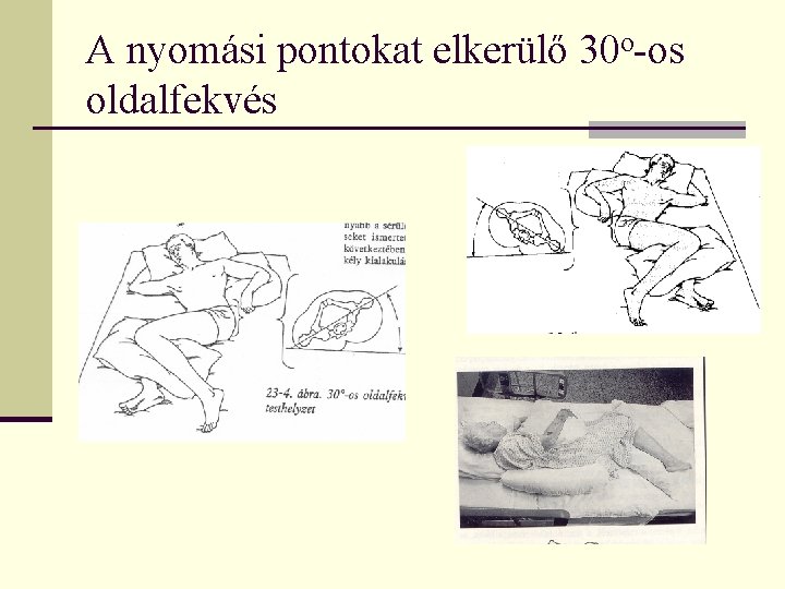 A nyomási pontokat elkerülő 30 o-os oldalfekvés 