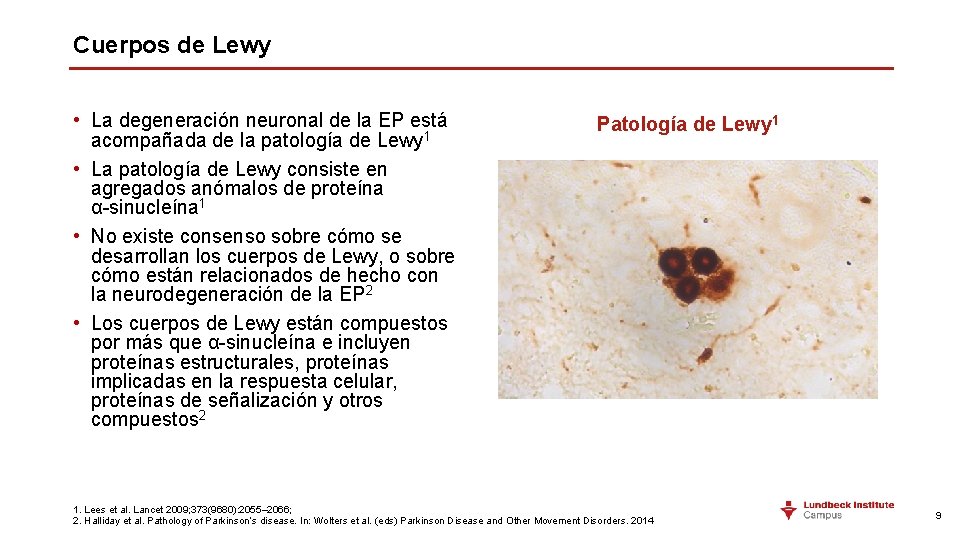 Cuerpos de Lewy • La degeneración neuronal de la EP está acompañada de la