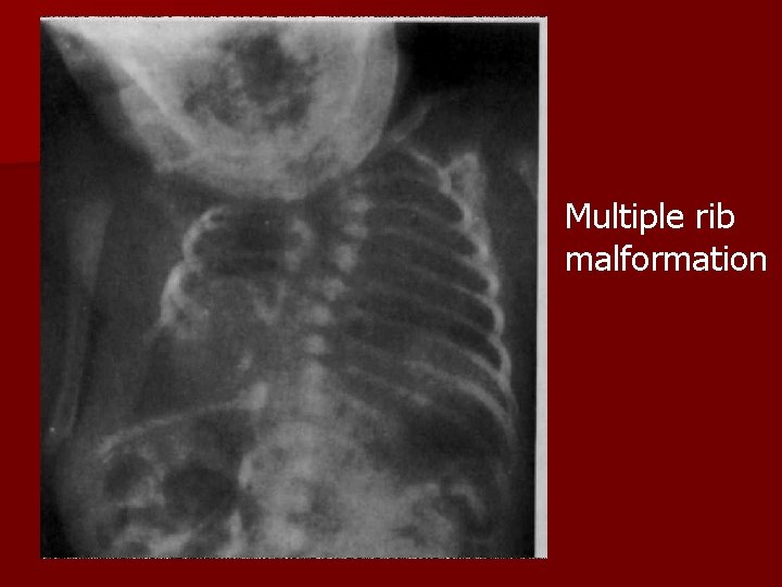 Multiple rib malformation 