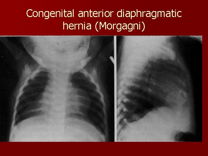 Congenital anterior diaphragmatic hernia (Morgagni) 