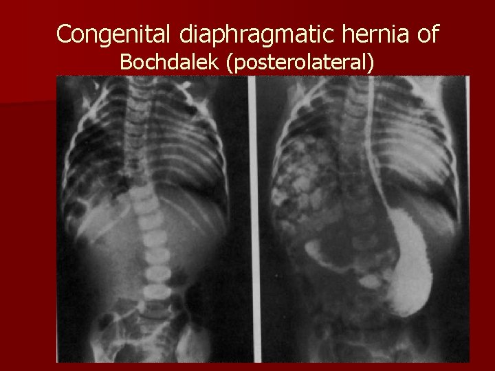 Congenital diaphragmatic hernia of Bochdalek (posterolateral) 