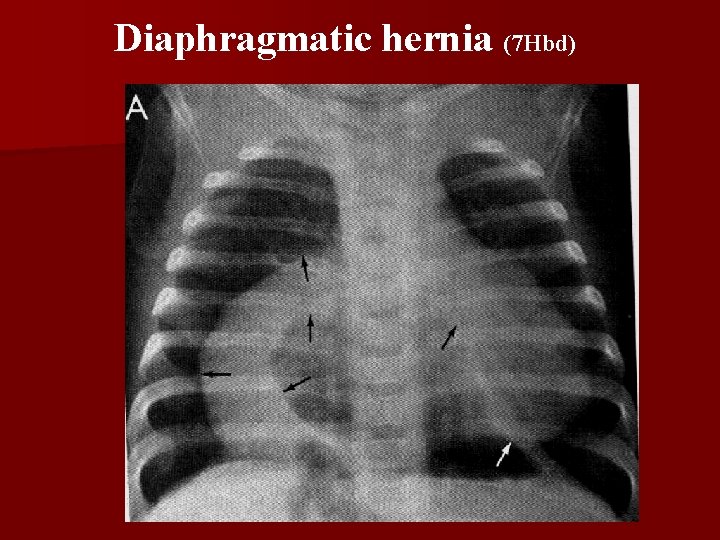 Diaphragmatic hernia (7 Hbd) 