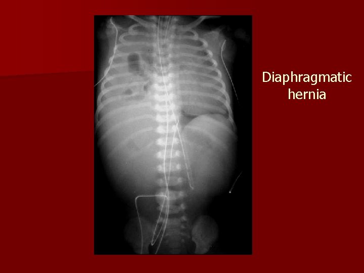 Diaphragmatic hernia 
