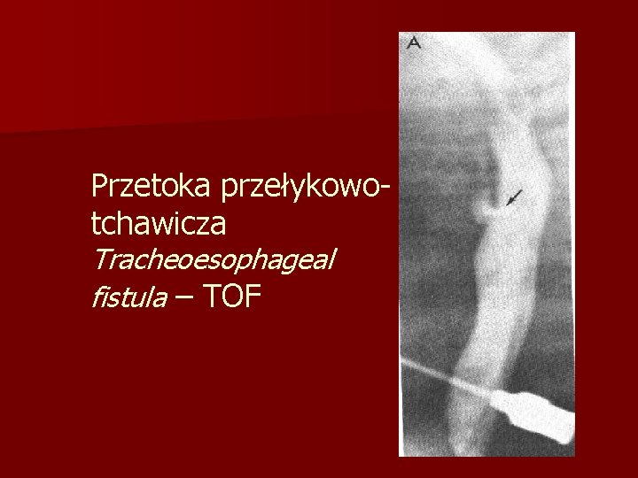 Przetoka przełykowotchawicza Tracheoesophageal fistula – TOF 