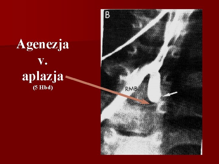 Agenezja v. aplazja (5 Hbd) 