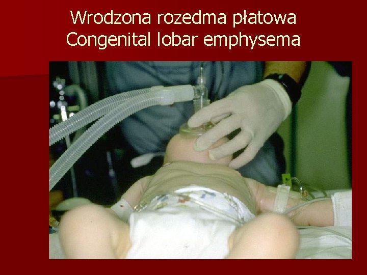 Wrodzona rozedma płatowa Congenital lobar emphysema 