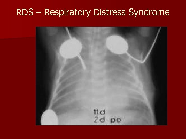 RDS – Respiratory Distress Syndrome 