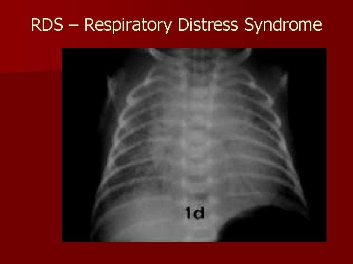 RDS – Respiratory Distress Syndrome 