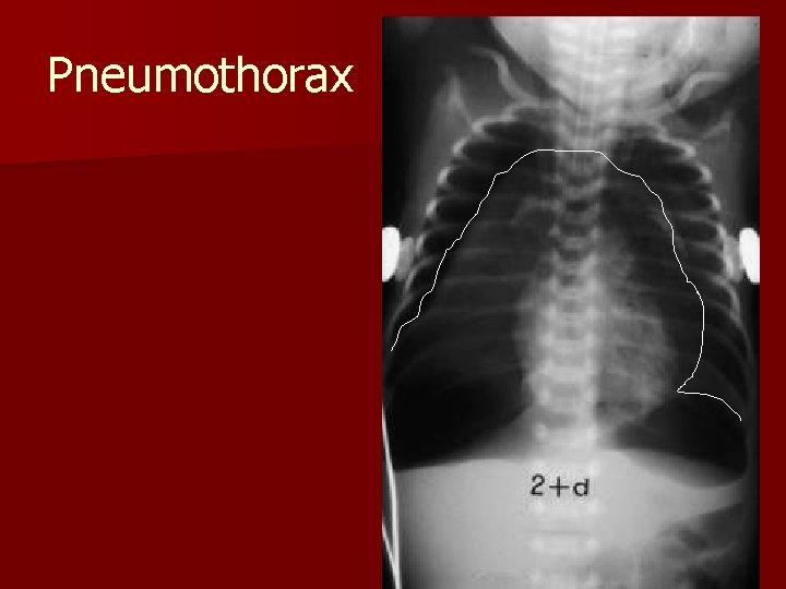 Pneumothorax 