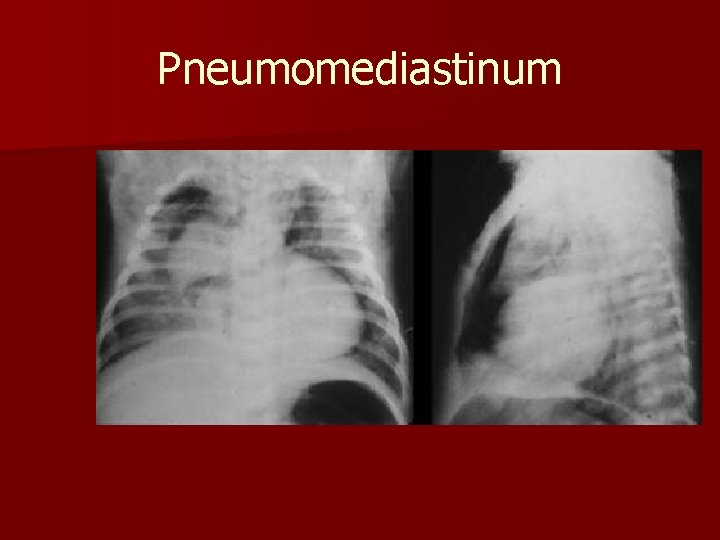 Pneumomediastinum 