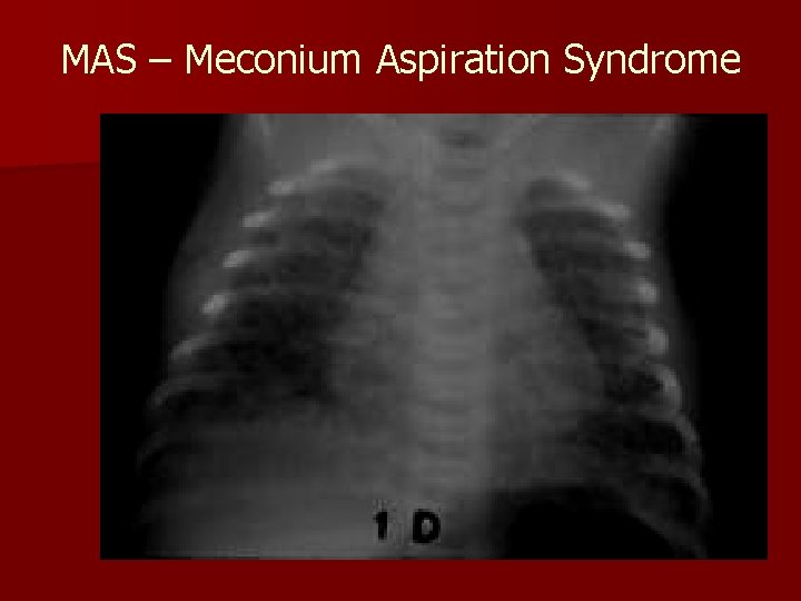 MAS – Meconium Aspiration Syndrome 