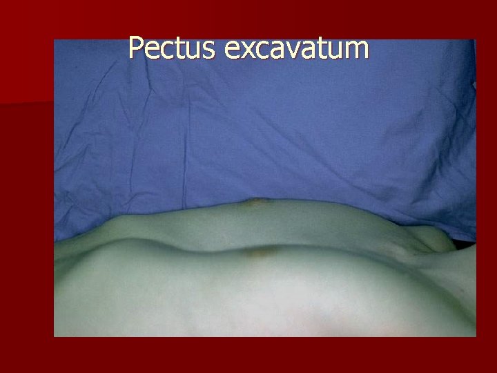 Pectus excavatum 
