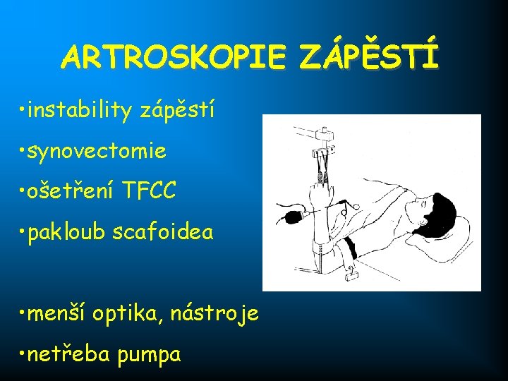 ARTROSKOPIE ZÁPĚSTÍ • instability zápěstí • synovectomie • ošetření TFCC • pakloub scafoidea •