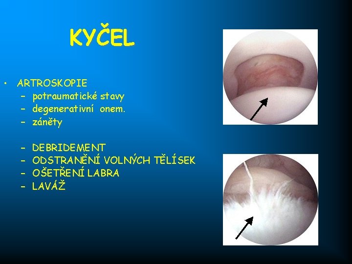 KYČEL • ARTROSKOPIE – potraumatické stavy – degenerativní onem. – záněty – – DEBRIDEMENT