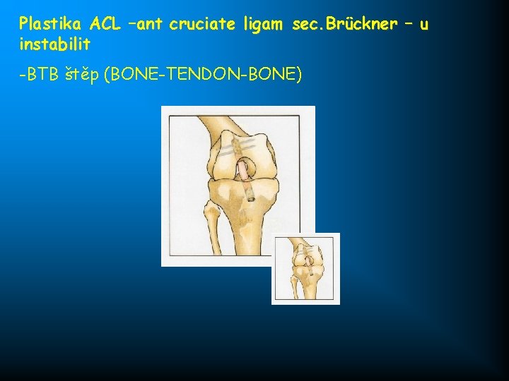 Plastika ACL –ant cruciate ligam sec. Brückner – u instabilit -BTB štěp (BONE-TENDON-BONE) 