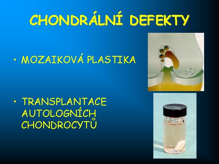 CHONDRÁLNÍ DEFEKTY • MOZAIKOVÁ PLASTIKA • TRANSPLANTACE AUTOLOGNÍCH CHONDROCYTŮ 