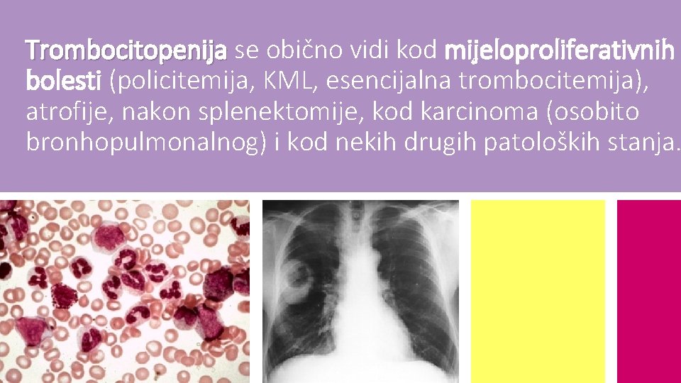 Trombocitopenija se obično vidi kod mijeloproliferativnih bolesti (policitemija, KML, esencijalna trombocitemija), atrofije, nakon splenektomije,