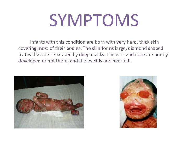 SYMPTOMS Infants with this condition are born with very hard, thick skin covering most