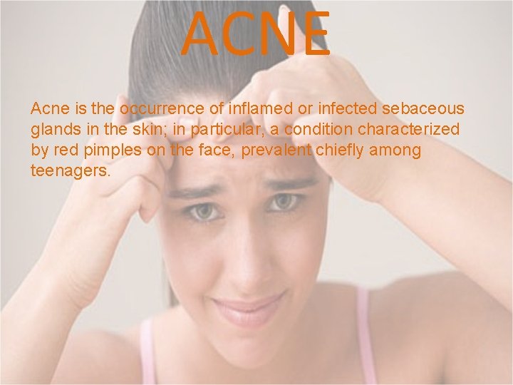 ACNE Acne is the occurrence of inflamed or infected sebaceous glands in the skin;
