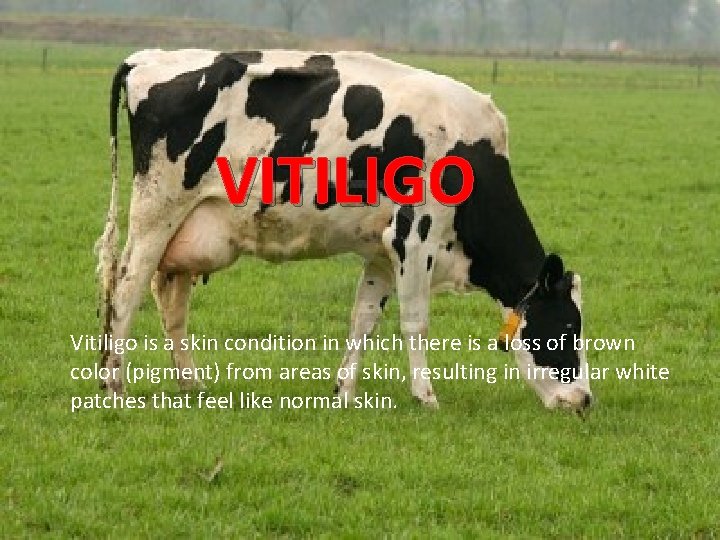 VITILIGO Vitiligo is a skin condition in which there is a loss of brown