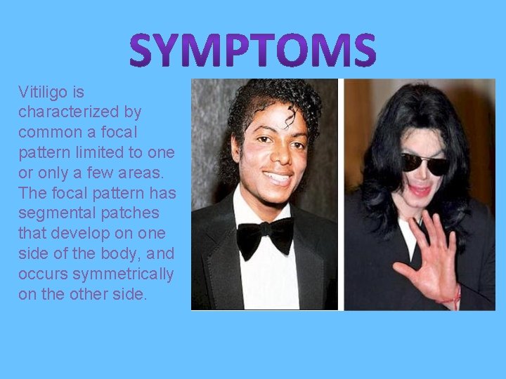 Vitiligo is characterized by common a focal pattern limited to one or only a