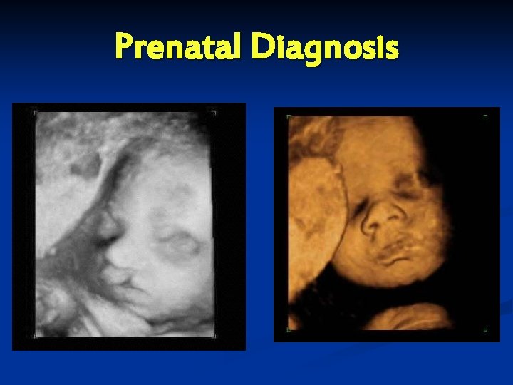 Prenatal Diagnosis 