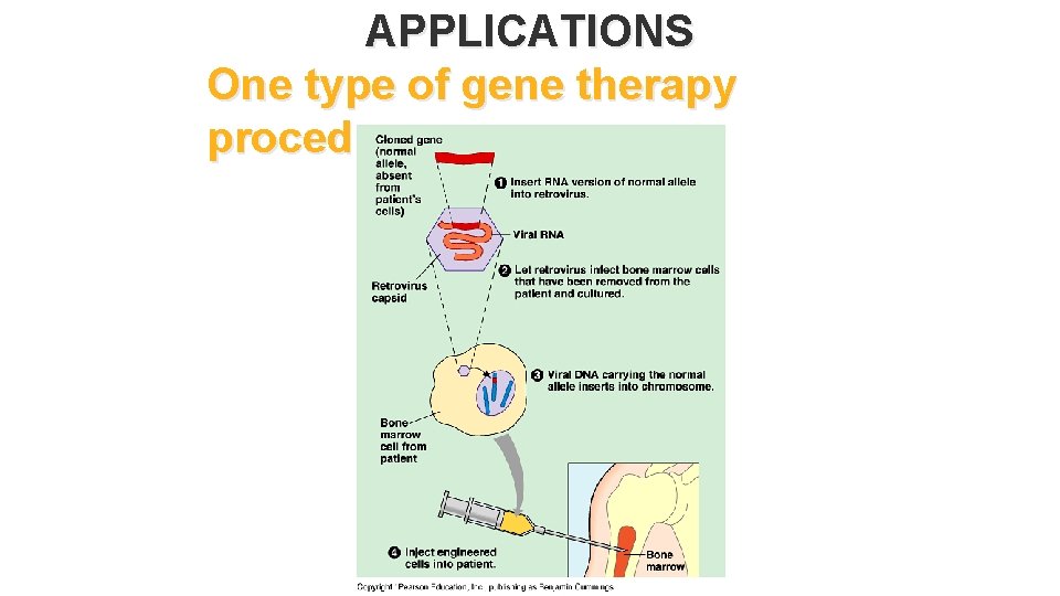 APPLICATIONS One type of gene therapy procedure 