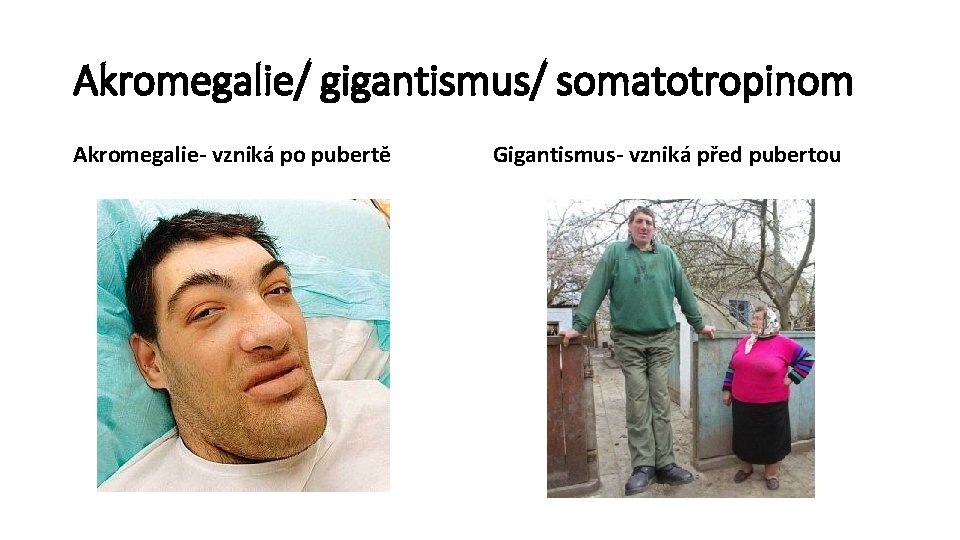 Akromegalie/ gigantismus/ somatotropinom Akromegalie- vzniká po pubertě Gigantismus- vzniká před pubertou 