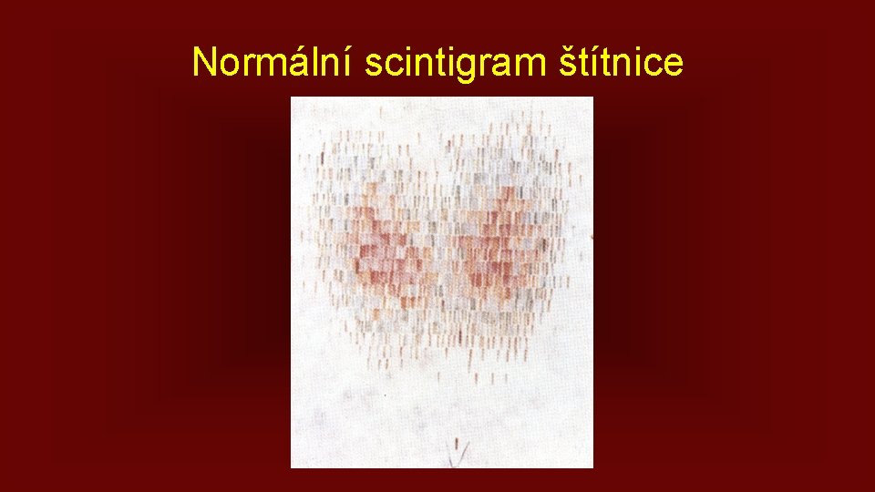 Normální scintigram štítnice 