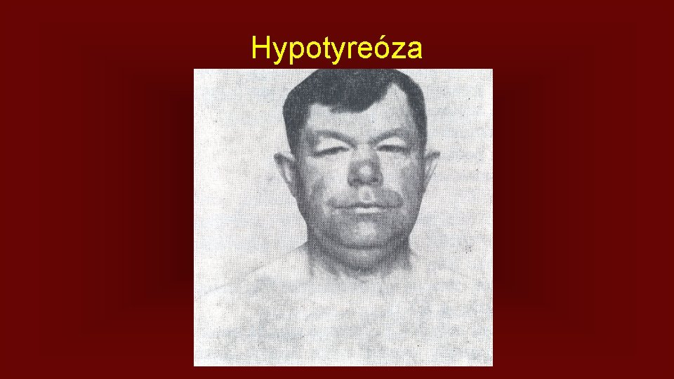 Hypotyreóza 