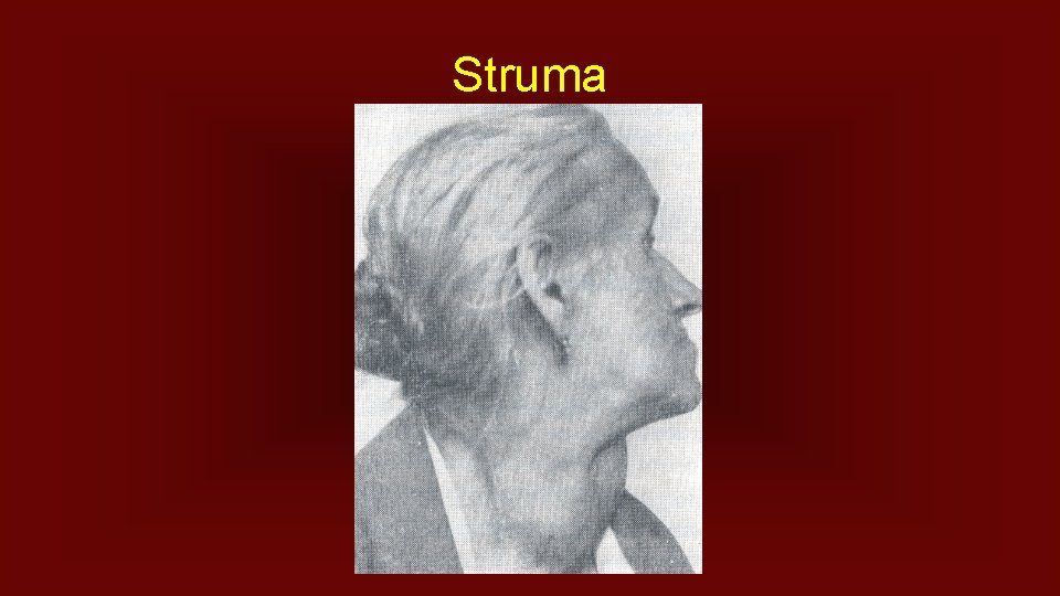 Struma 