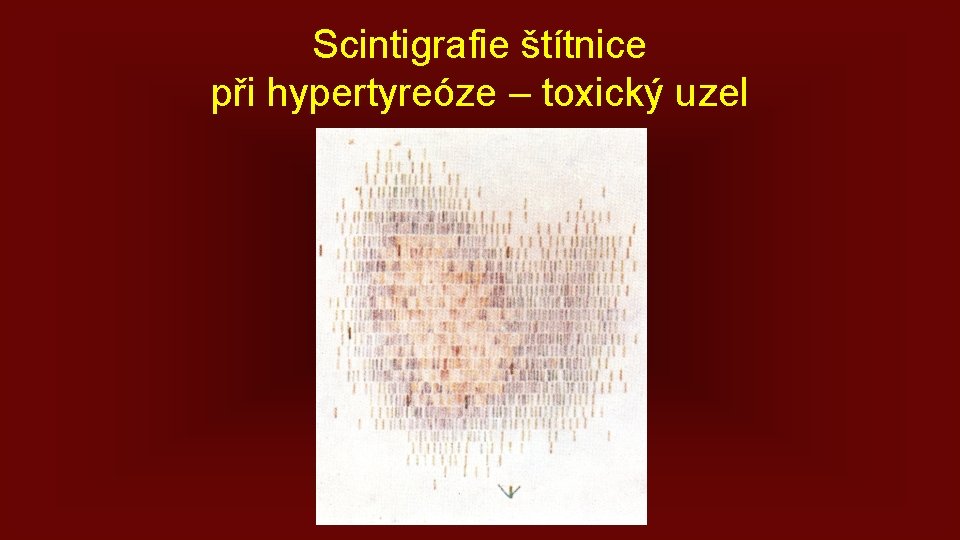 Scintigrafie štítnice při hypertyreóze – toxický uzel 