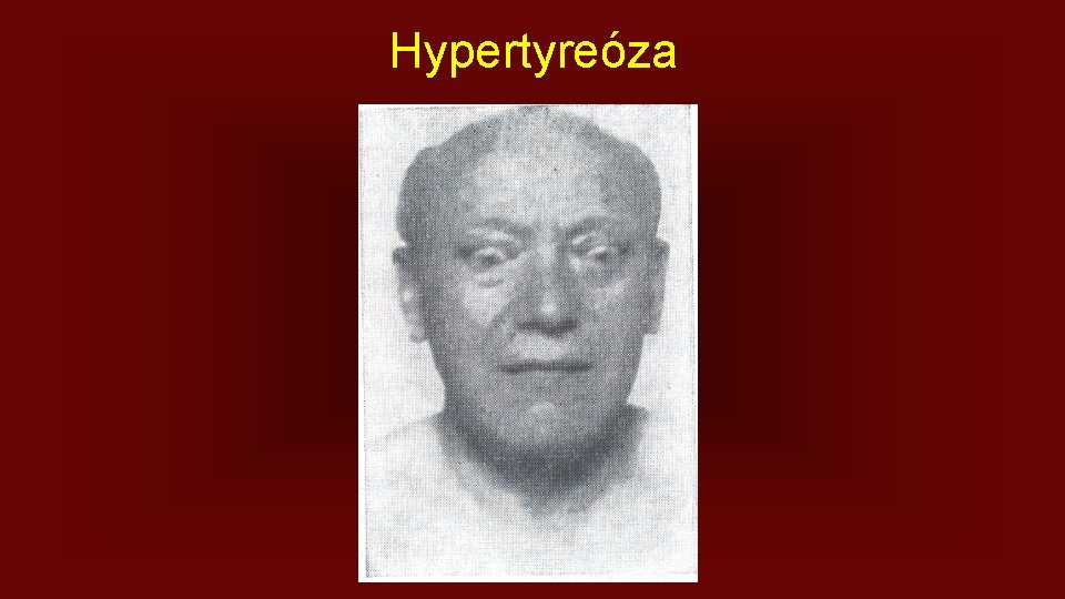 Hypertyreóza 