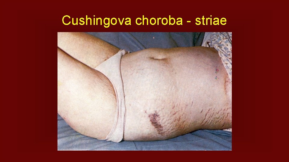 Cushingova choroba - striae 