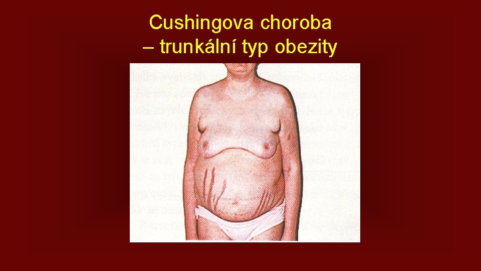 Cushingova choroba – trunkální typ obezity 