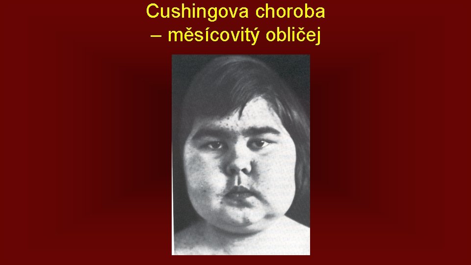 Cushingova choroba – měsícovitý obličej 